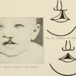 Who Is Disfigured by a Cleft Lip?