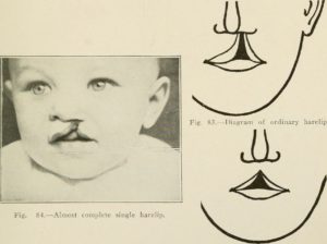Who Is Disfigured by a Cleft Lip?